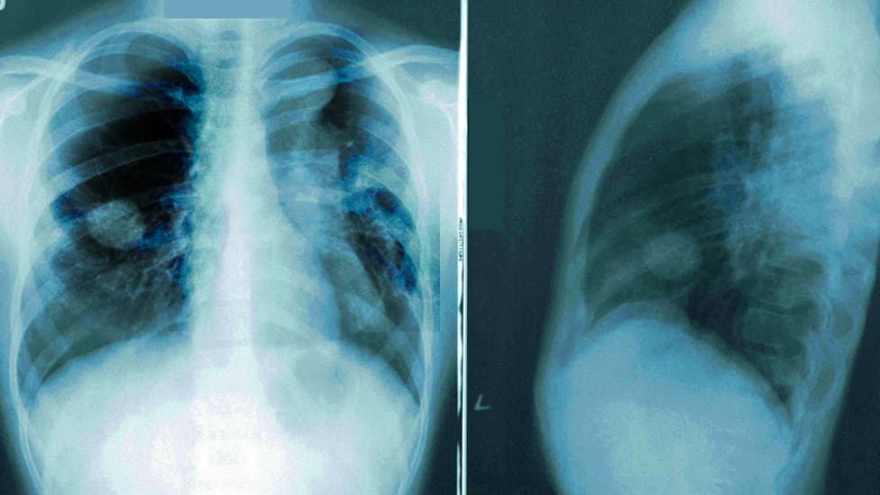 Synthetic X-ray Images of Lung Cancer Patients